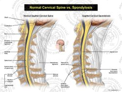 Normal Cervical Spine vs. Spondylosis