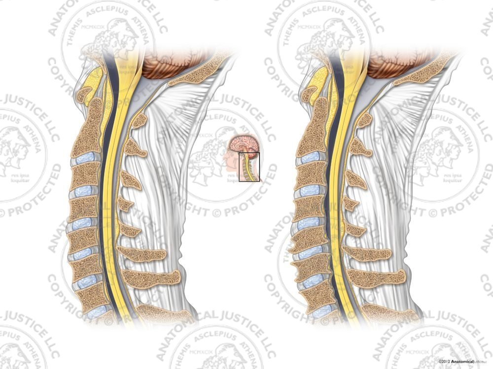 Normal Cervical Spine vs. Spondylosis – No Text