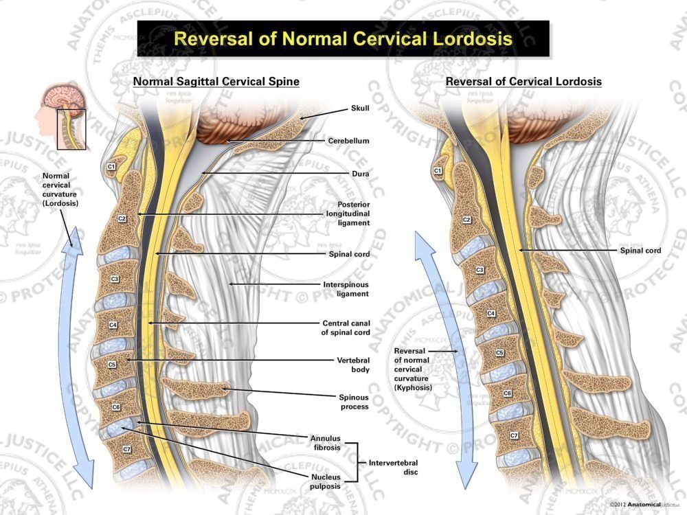 Normal vs. Reversal of Cervical Lordosis