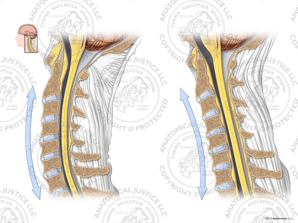 Normal vs. Reversal of Cervical Lordosis – No Text