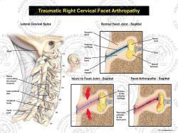 Traumatic Right Cervical Facet Arthropathy