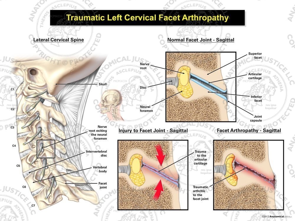Traumatic Left Cervical Facet Arthropathy