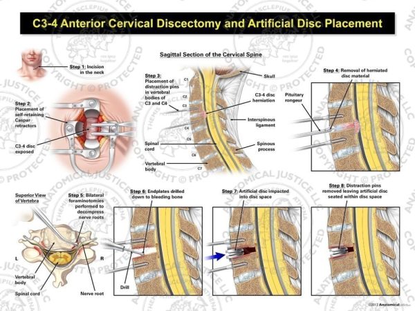 8 illustrations depict the process of a c3-4 ACDF with artificial disc placement.