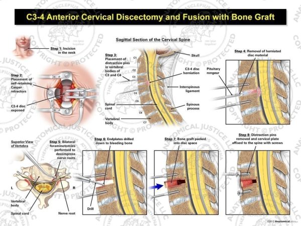 C3 4 Anterior Cervical Discectomy And Fusion With Bone Graft