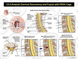 C3-4 Anterior Cervical Discectomy and Fusion with PEEK Cage