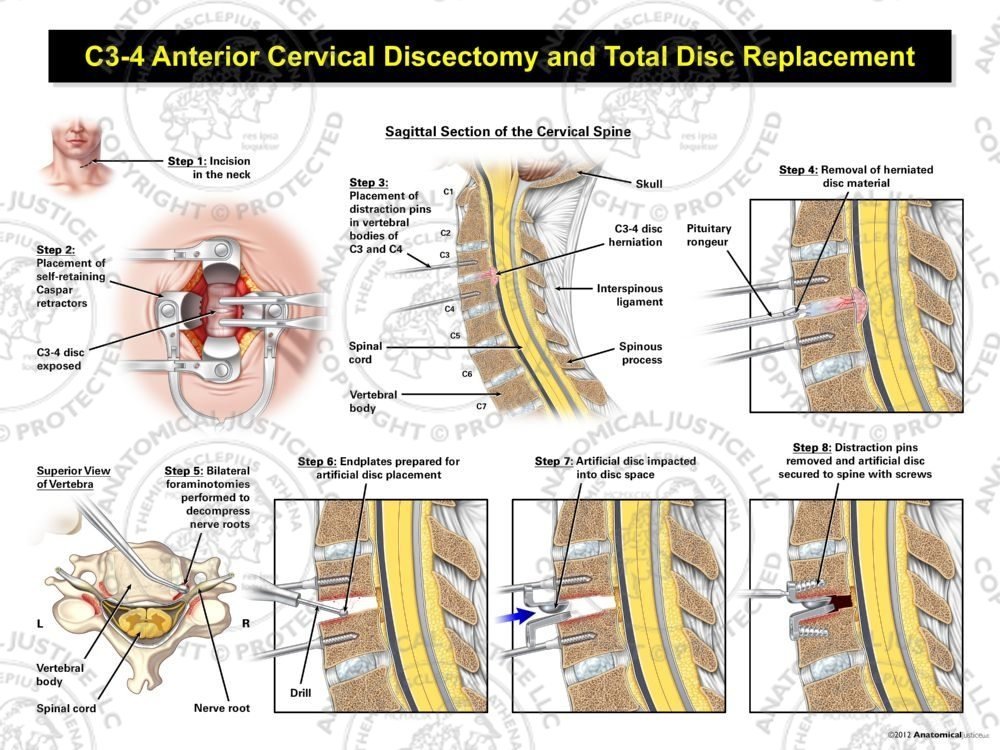 C3-4 Anterior Cervical Discectomy and Total Disc Replacement