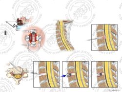 Male C3-4 Anterior Cervical Discectomy Utilizing Traction and Artificial Disc Placement – No Text