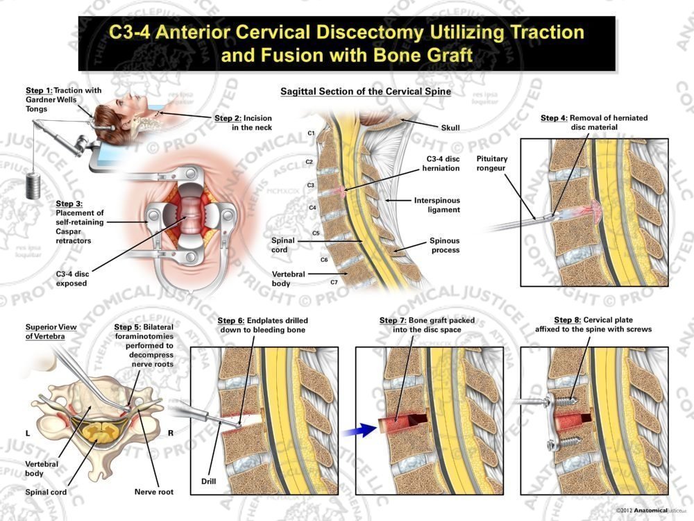 Female C3-4 Anterior Cervical Discectomy Utilizing Traction and Fusion with Bone Graft