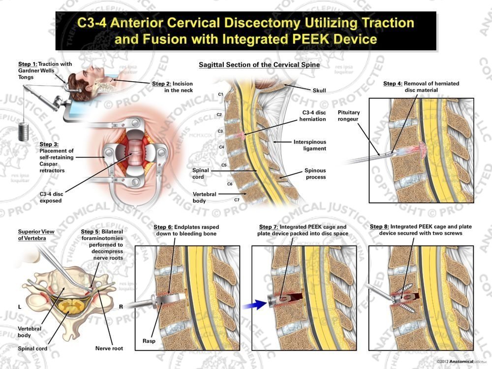 Male C3-4 Anterior Cervical Discectomy Utilizing Traction and Fusion with Integrated PEEK Device