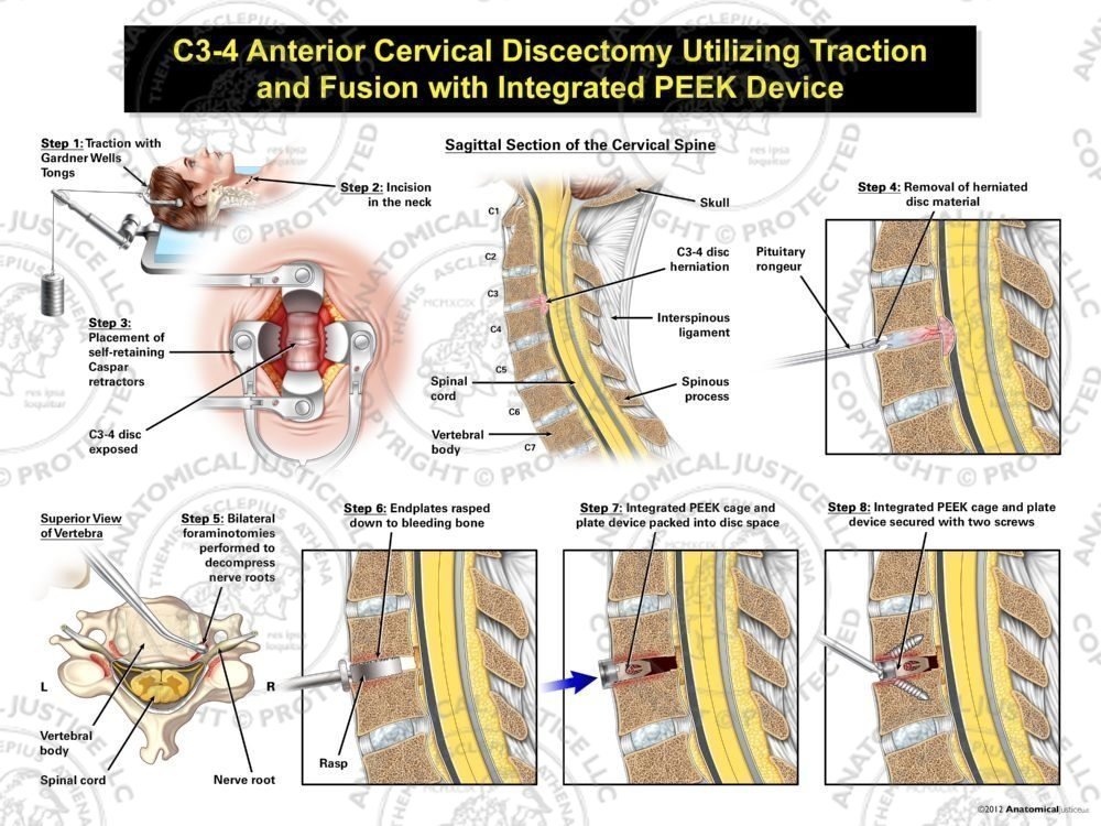 Female C3-4 Anterior Cervical Discectomy Utilizing Traction and Fusion with Integrated PEEK Device