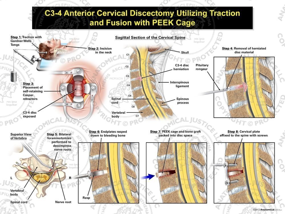 Female C3-4 Anterior Cervical Discectomy Utilizing Traction and Fusion with PEEK Cage