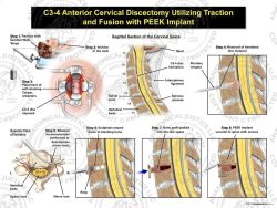 Female C3-4 Anterior Cervical Discectomy Utilizing Traction and Fusion with PEEK Implant