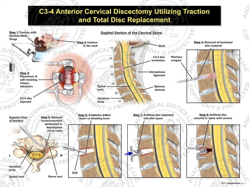Male C3-4 Anterior Cervical Discectomy Utilizing Traction and Total Disc Replacement