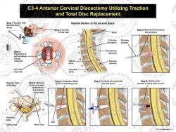 Female C3-4 Anterior Cervical Discectomy Utilizing Traction and Total Disc Replacement