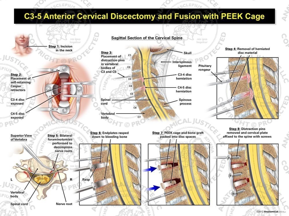 C3-5 Anterior Cervical Discectomy and Fusion with PEEK Cage