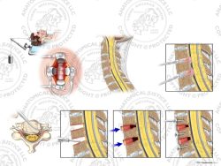 Male C3-5 Anterior Cervical Discectomy Utilizing Traction and Fusion with Bone Graft – No Text