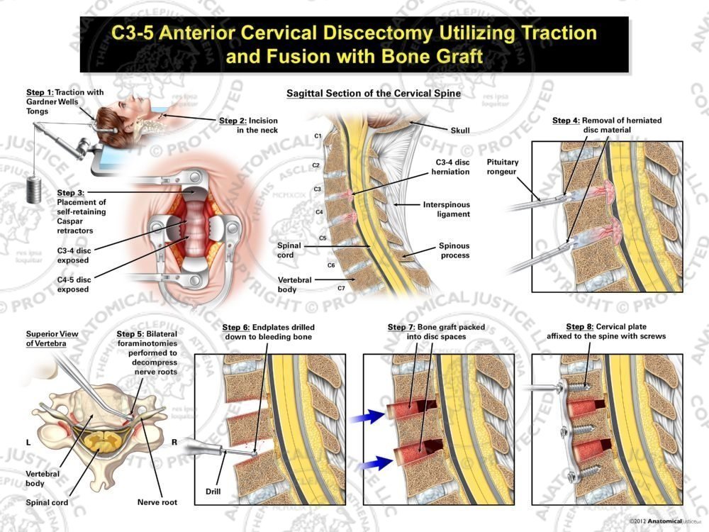 Female C3-5 Anterior Cervical Discectomy Utilizing Traction and Fusion with Bone Graft