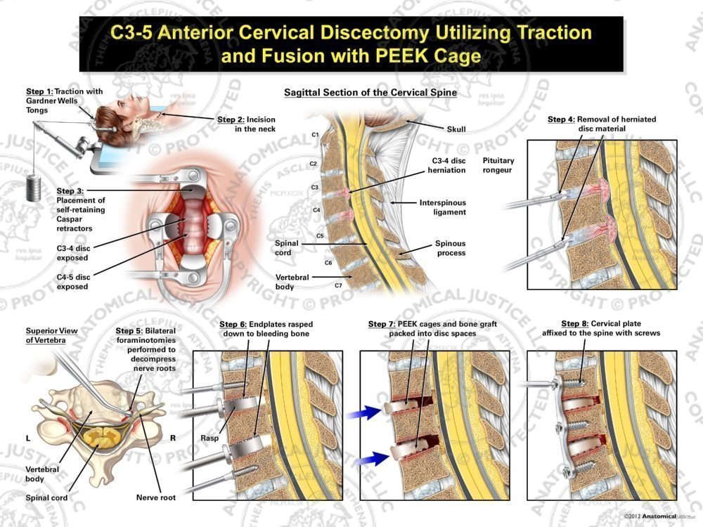 Female C3-5 Anterior Cervical Discectomy Utilizing Traction and Fusion with PEEK Cage