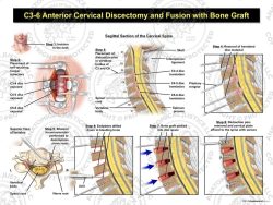 C3-6 Anterior Cervical Discectomy and Fusion with Bone Graft