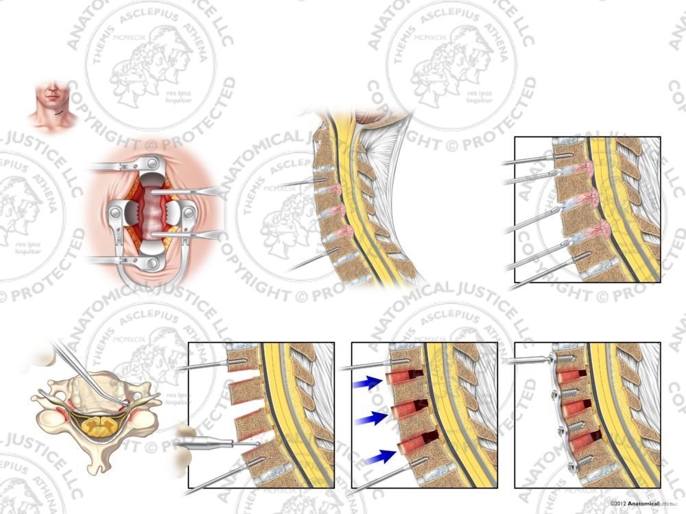 C3-6 Anterior Cervical Discectomy and Fusion with Bone Graft – No Text