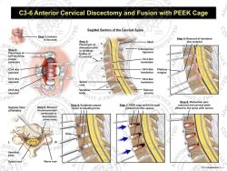 C3-6 Anterior Cervical Discectomy and Fusion with PEEK Cage