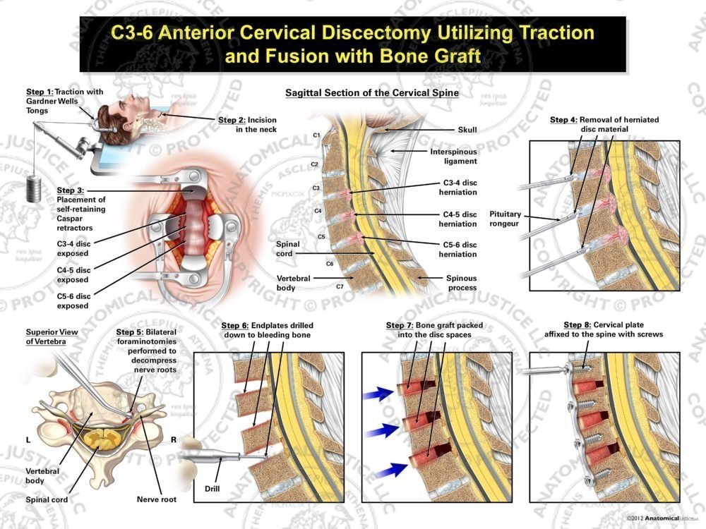 Male C3-6 Anterior Cervical Discectomy Utilizing Traction and Fusion with Bone Graft