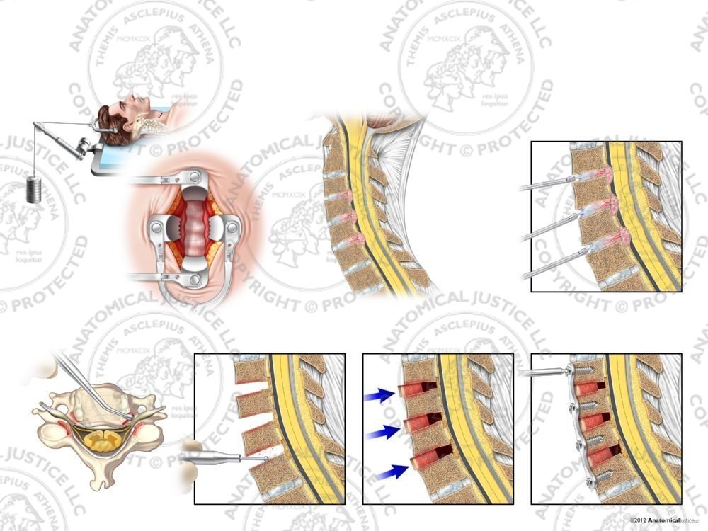 Male C3-6 Anterior Cervical Discectomy Utilizing Traction and Fusion with Bone Graft – No Text