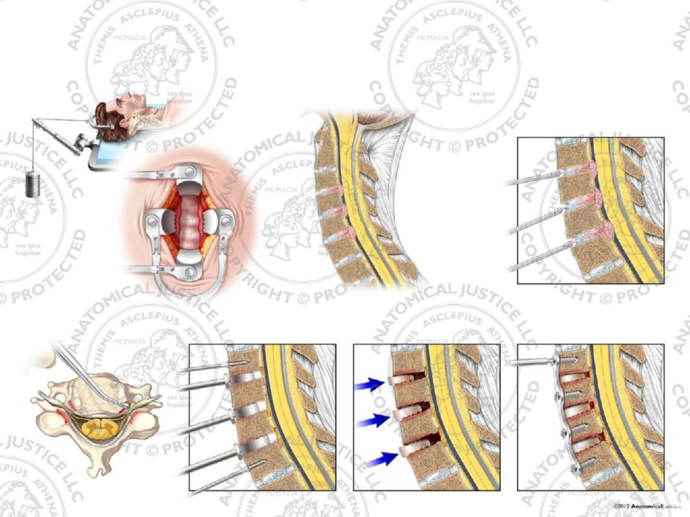Male C3-6 Anterior Cervical Discectomy Utilizing Traction and Fusion with PEEK Cage – No Text