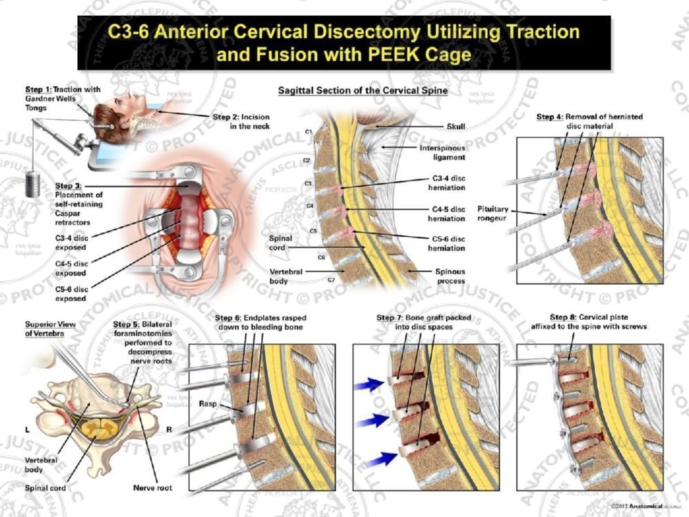 Female C3-6 Anterior Cervical Discectomy Utilizing Traction and Fusion with PEEK Cage