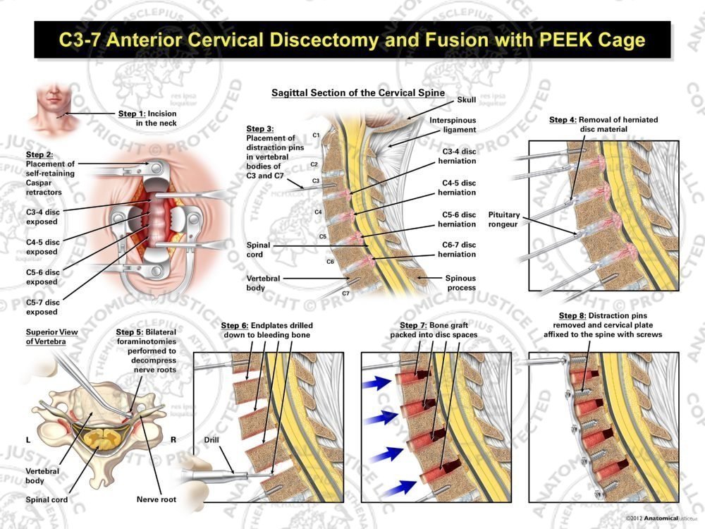 C3-7 Anterior Cervical Discectomy and Fusion with Bone Graft