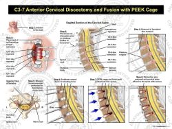 C3-7 Anterior Cervical Discectomy and Fusion with PEEK Cage