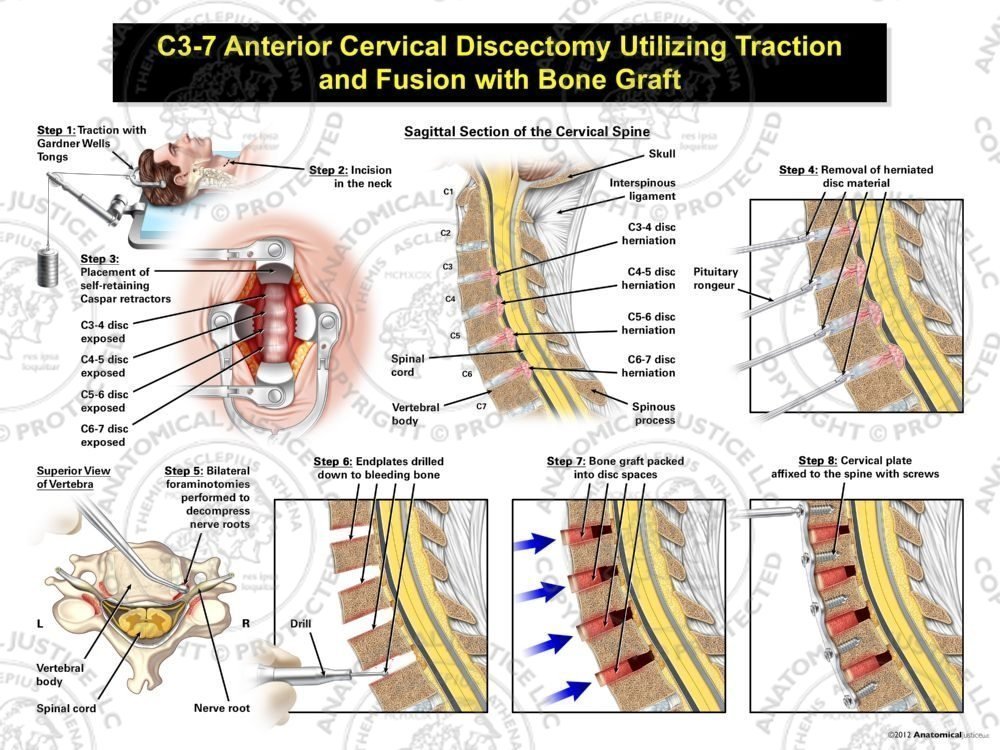 Male C3-7 Anterior Cervical Discectomy Utilizing Traction and Fusion with Bone Graft