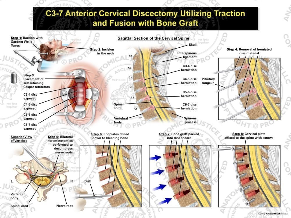 Female C3-7 Anterior Cervical Discectomy Utilizing Traction and Fusion with Bone Graft