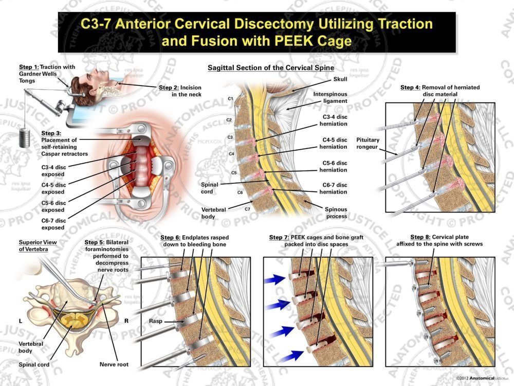 Male C3-7 Anterior Cervical Discectomy Utilizing Traction and Fusion with PEEK Cage