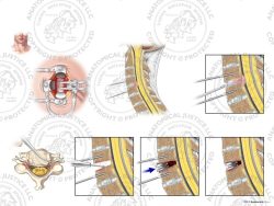 C4-5 Anterior Cervical Discectomy and Artificial Disc Placement – No Text