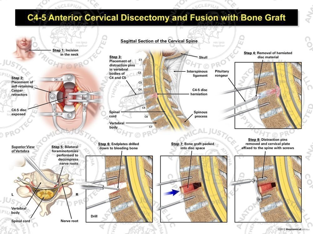C4-5 Anterior Cervical Discectomy and Fusion with Bone Graft