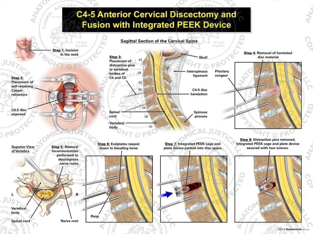 C4-5 Anterior Cervical Discectomy and Fusion with Integrated PEEK Device