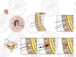 C4-5 Anterior Cervical Discectomy and Fusion with Integrated PEEK Device – No Text