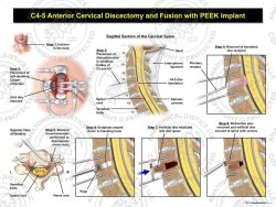 C4-5 Anterior Cervical Discectomy and Fusion with PEEK Implant