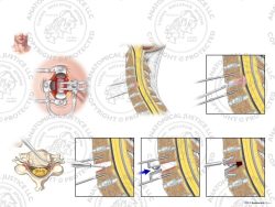C4-5 Anterior Cervical Discectomy and Total Disc Replacement – No Text
