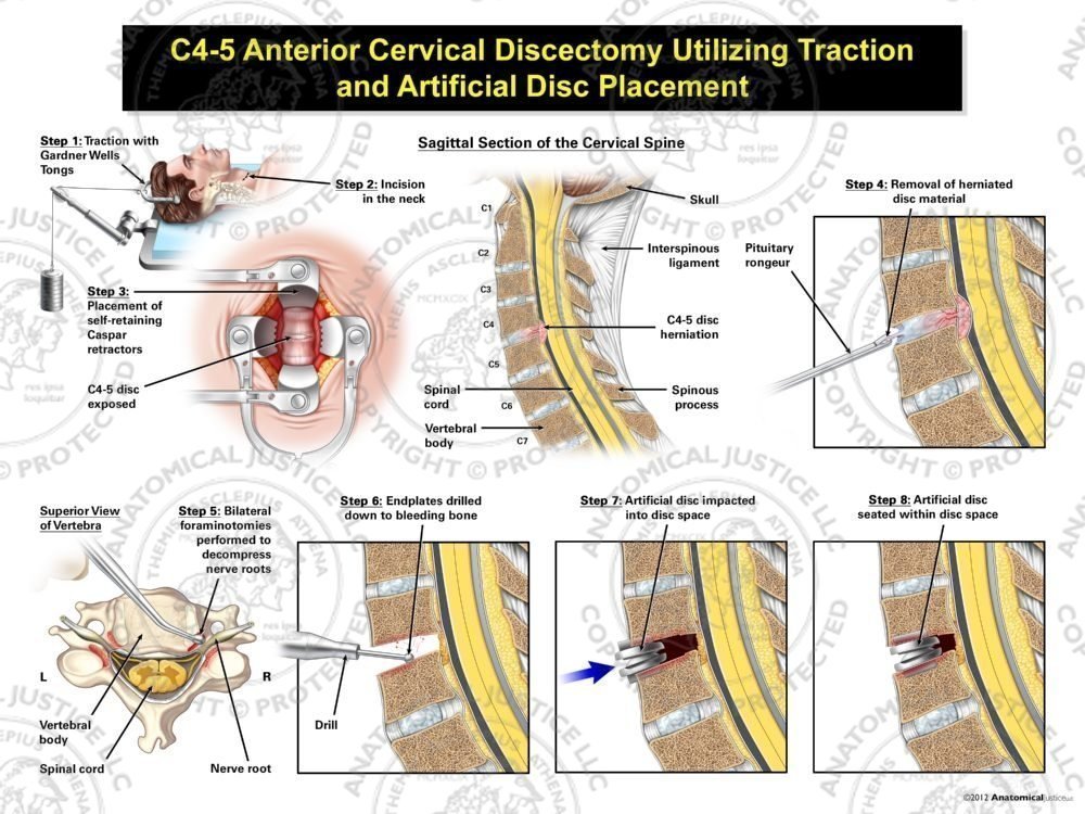 Male C4-5 Anterior Cervical Discectomy Utilizing Traction and Artificial Disc Placement