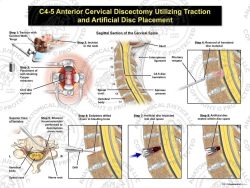 Female C4-5 Anterior Cervical Discectomy Utilizing Traction and Artificial Disc Placement