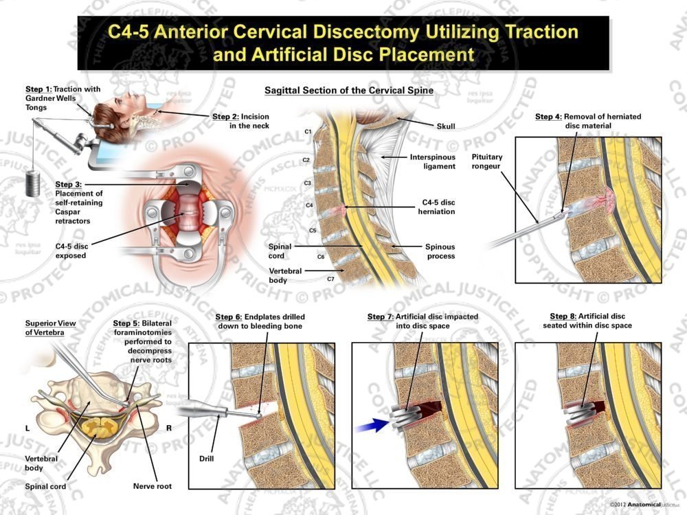 Female C4-5 Anterior Cervical Discectomy Utilizing Traction and Artificial Disc Placement