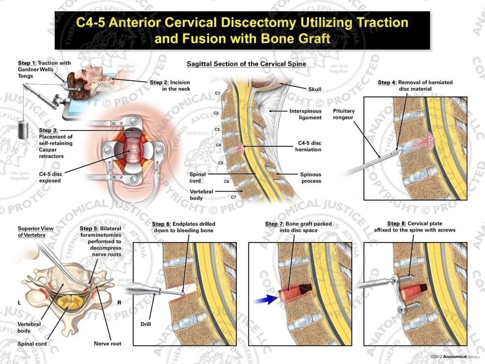 Male C4-5 Anterior Cervical Discectomy Utilizing Traction and Fusion with Bone Graft