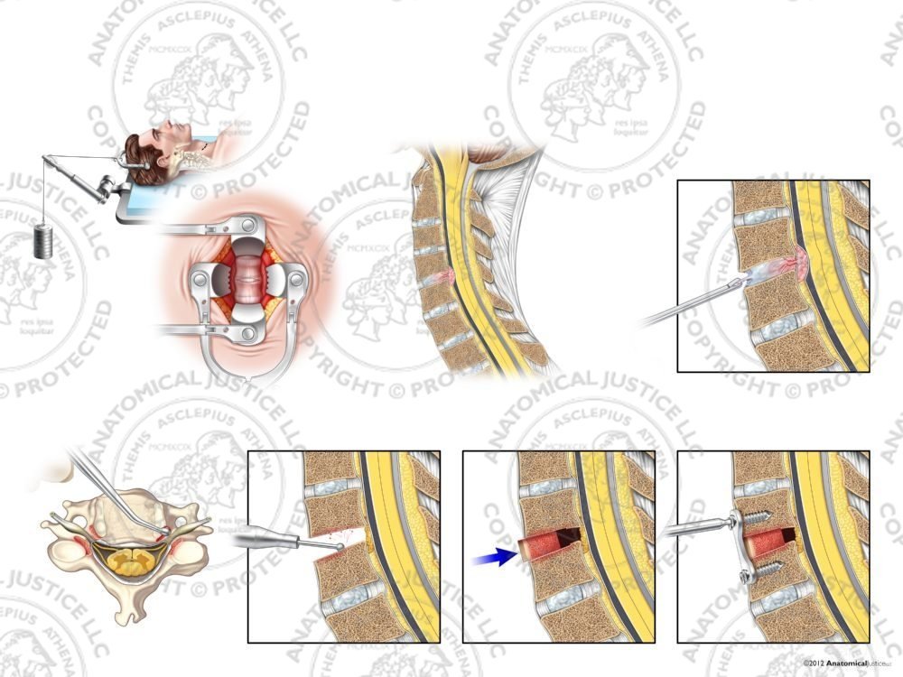 Male C4-5 Anterior Cervical Discectomy Utilizing Traction and Fusion with Bone Graft – No Text