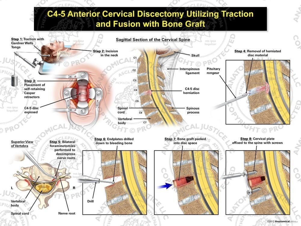Female C4-5 Anterior Cervical Discectomy Utilizing Traction and Fusion with Bone Graft