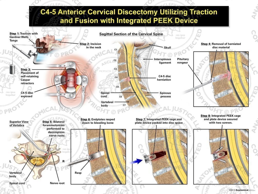 Male C4-5 Anterior Cervical Discectomy Utilizing Traction and Fusion with Integrated PEEK Device