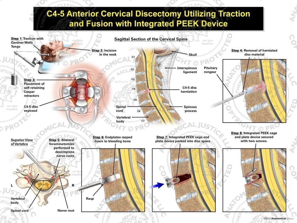 Female C4-5 Anterior Cervical Discectomy Utilizing Traction and Fusion with Integrated PEEK Device