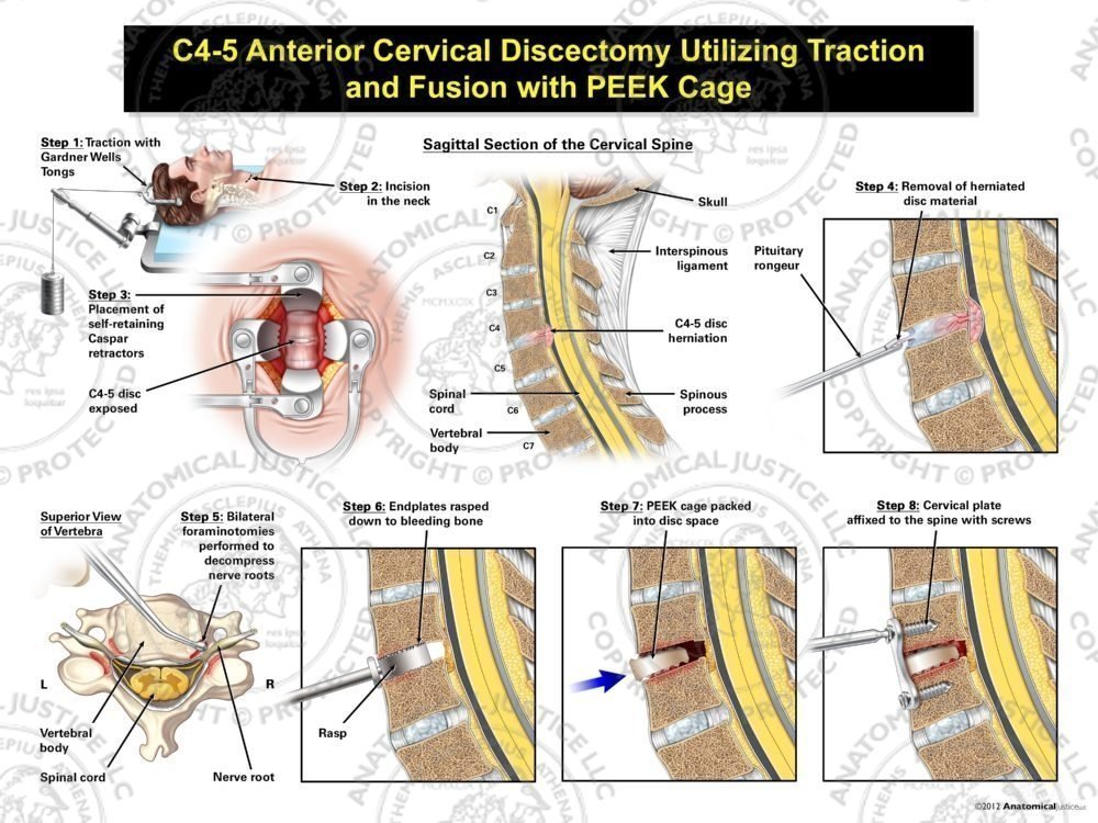 Male C4-5 Anterior Cervical Discectomy Utilizing Traction and Fusion with PEEK Cage