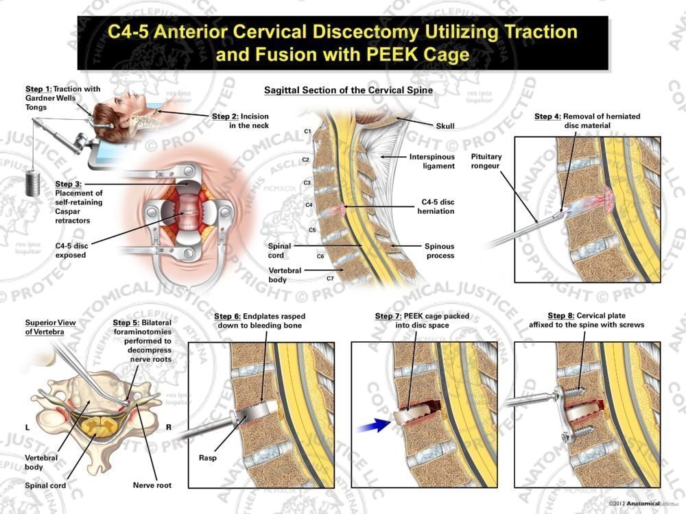 Female C4-5 Anterior Cervical Discectomy Utilizing Traction and Fusion with PEEK Cage